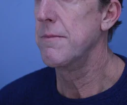 Facelift & Neck Lift