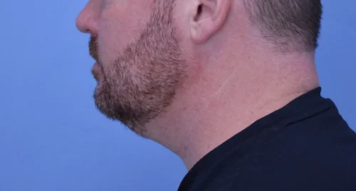 Facelift & Neck Lift