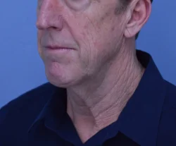 Facelift & Neck Lift