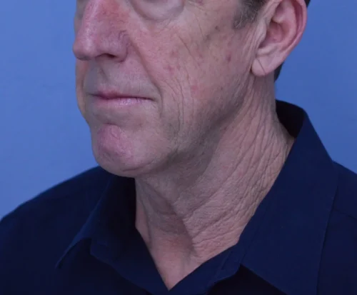 Facelift & Neck Lift