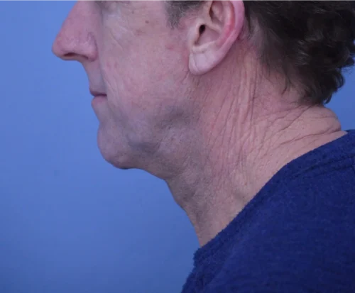 Facelift & Neck Lift