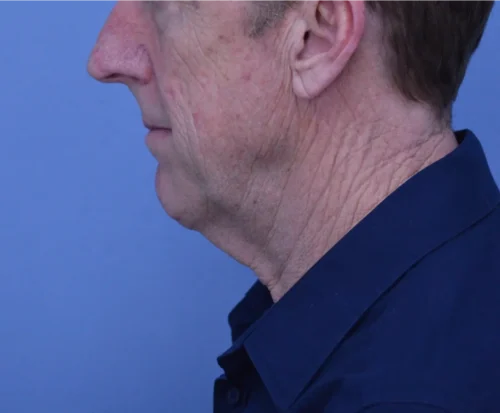 Facelift & Neck Lift