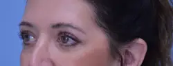 Blepharoplasty