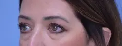 Blepharoplasty