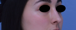 Rhinoplasty