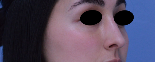 Rhinoplasty