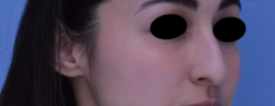 Rhinoplasty