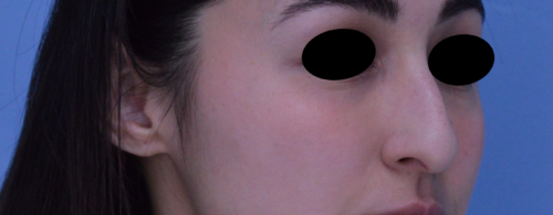 Rhinoplasty