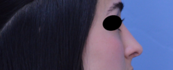 Rhinoplasty