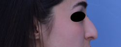 Rhinoplasty