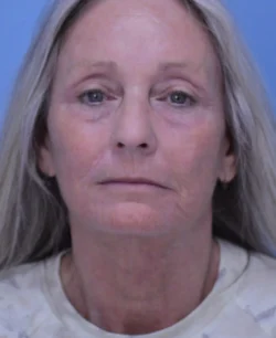 Facelift & Neck Lift