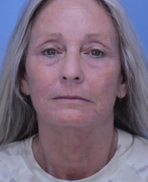Facelift & Neck Lift