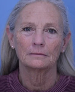 Facelift & Neck Lift
