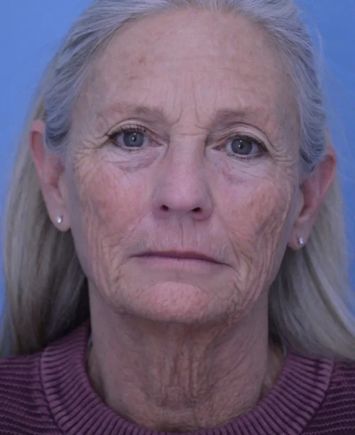 Facelift & Neck Lift
