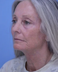 Facelift & Neck Lift