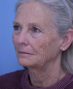 Facelift & Neck Lift