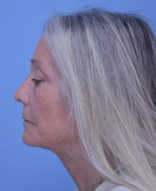 Facelift & Neck Lift