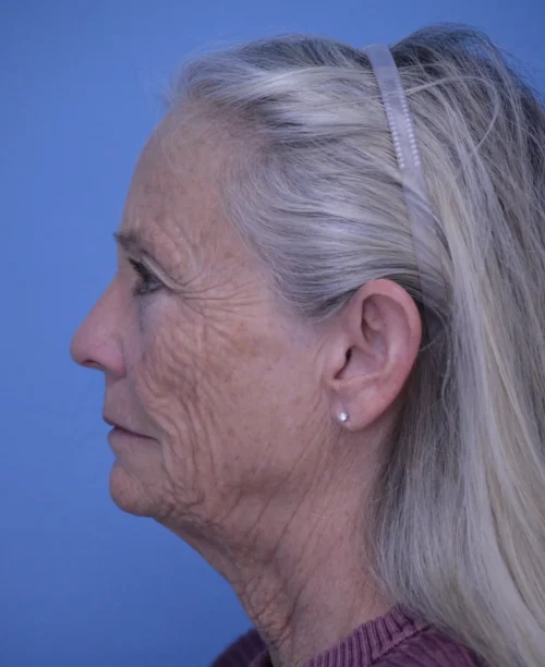 Facelift & Neck Lift
