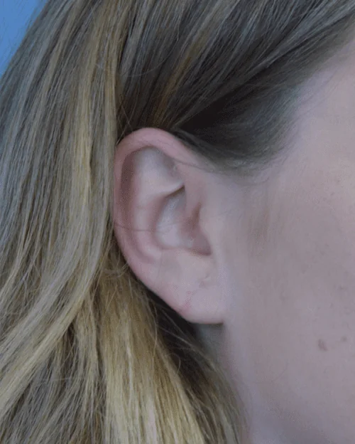 Mini-Facelift Before & After